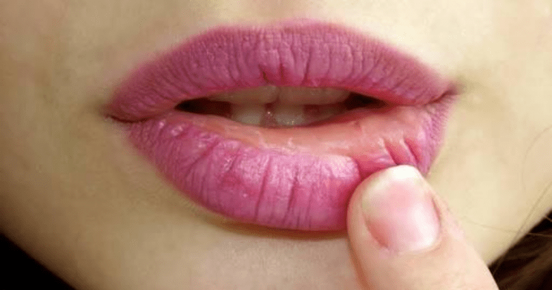 Потрескавшиеся губы. Причины и лечение